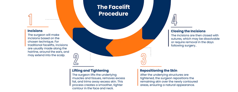 Facelift surgery procedure illustration