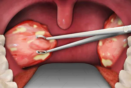 Tonsils and adenoids treatment overview