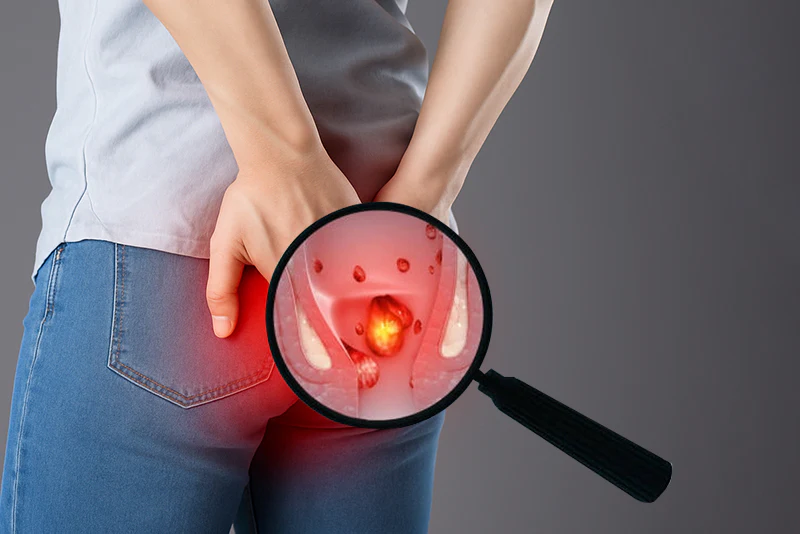 Illustration explaining an anal fistula