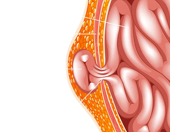 Hernia surgery treatment overview