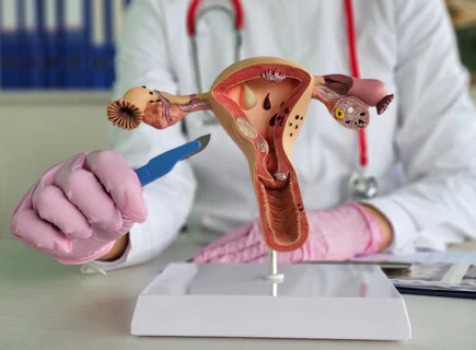 Illustration explaining complete uterus removal