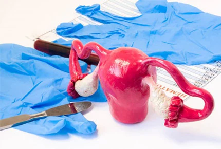 Fibroid removal and myomectomy overview