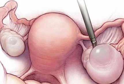 Types of ovarian cysts treated surgically