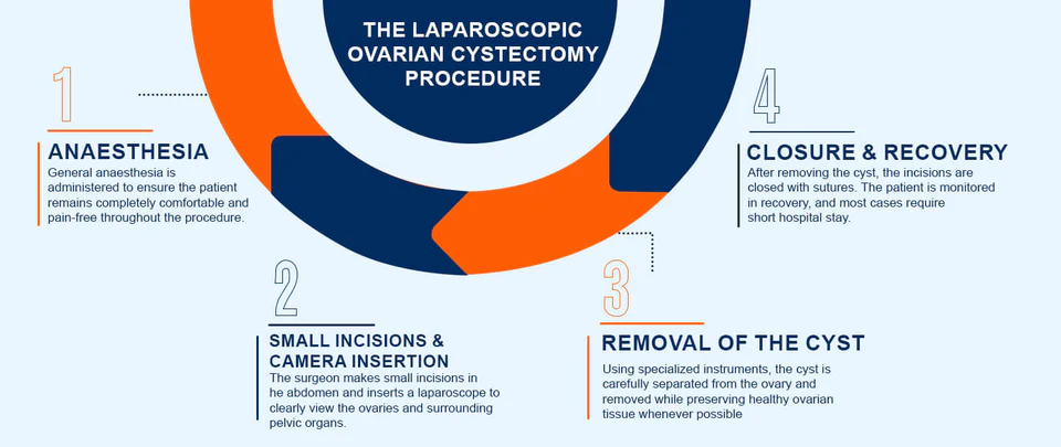 Ovarian cystectomy procedure overview
