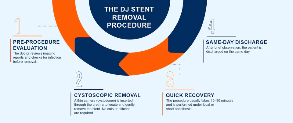 Day-care DJ stent removal procedure overview