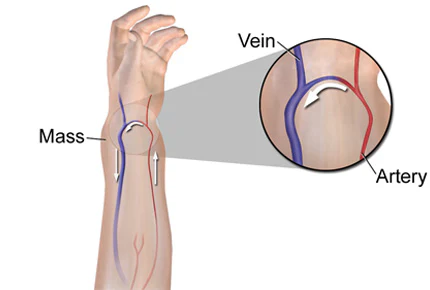 Illustration explaining an AV fistula for dialysis