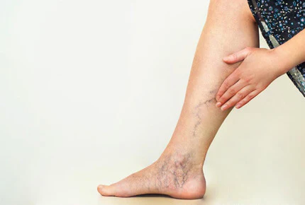 Illustration explaining varicose veins