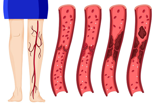  Blood Clots