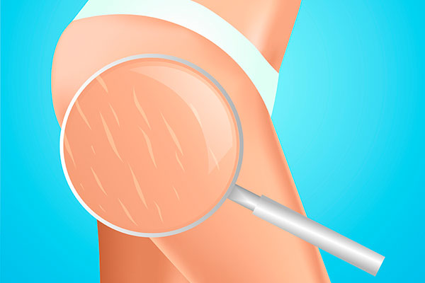  Scar Tissue Formation