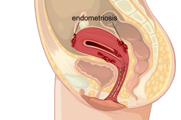 Endometriosis