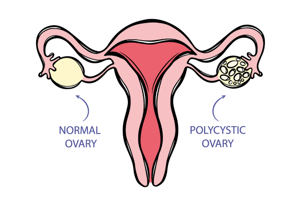 Polycystic Ovary Syndrome (PCOS)