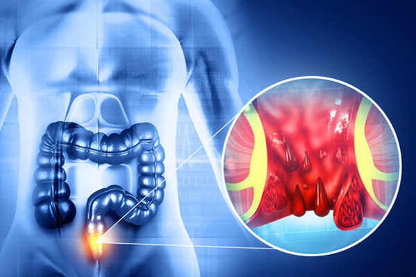Anal Gland Infection