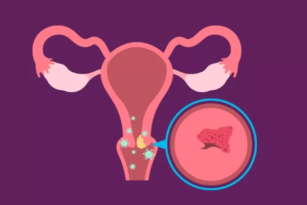 Cervical Mucus Issues