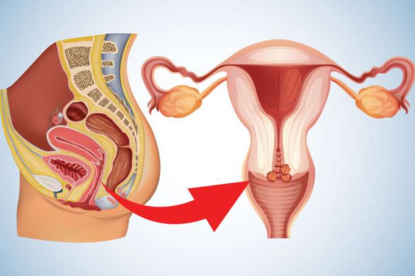 Uterine or Cervical Problems