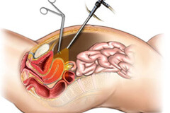 Injury to Surrounding Organs