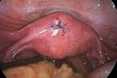 Uterine Perforation