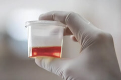 Blood in Urine