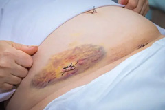 Reaction to Anaesthesia