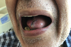 Speech or Swallowing Difficulty