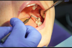 Swelling & Airway Concerns