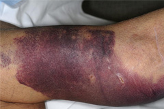 Swelling or Bruising