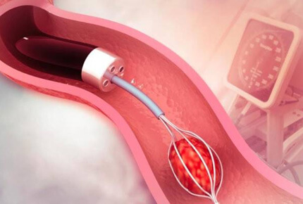 Stent-Related Symptoms